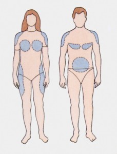 Различие жировых отложений по мужскому и женскому типу